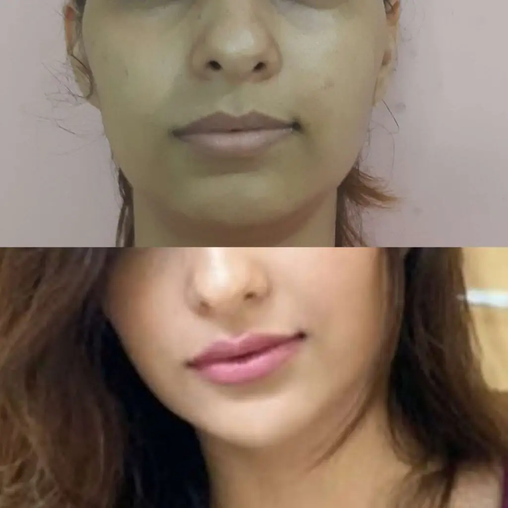 Lip Enhancement with fillers | Plastic Surgeon in Mumbai - Dr. Shraddha Deshpande