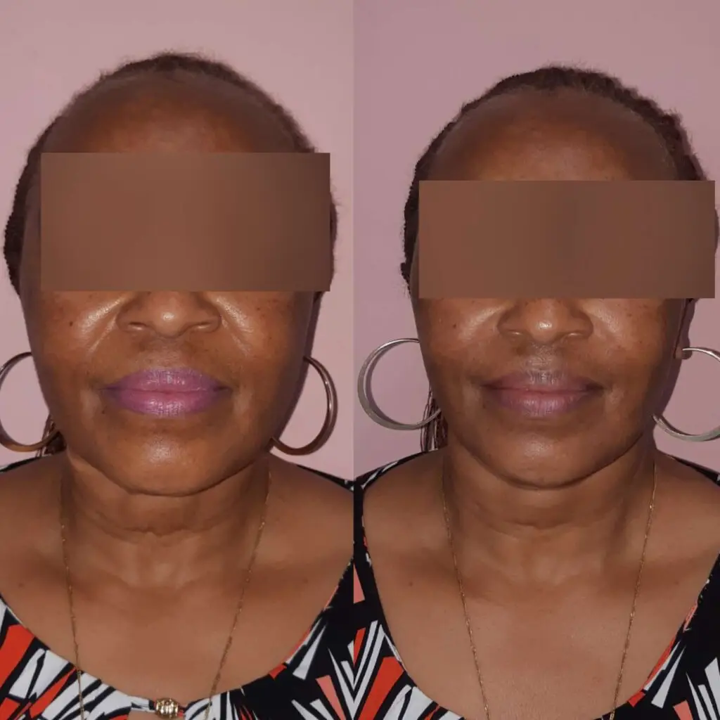 Facelift and Necklift with Jaw enhancement | Plastic Surgeon in Mumbai - Dr. Shraddha Deshpande