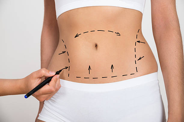 Liposuction in South Mumbai
