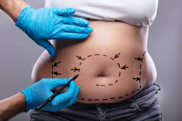 Tummy Tuck Surgery in South Mumbai