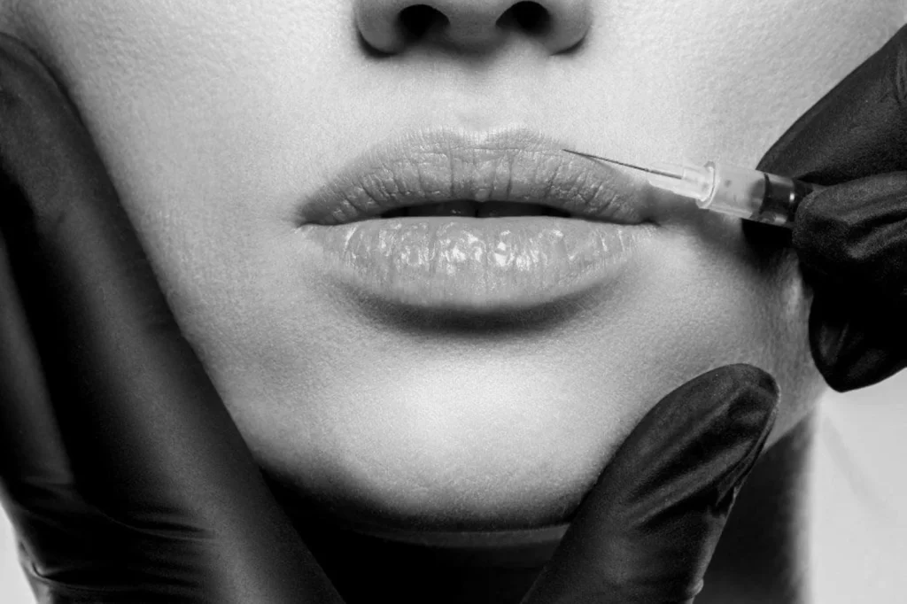 Lip Augmentation