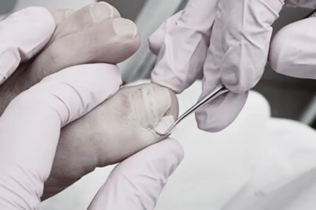 Ingrown Toenail Excision