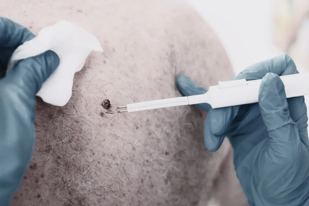 Skin Tag Removal