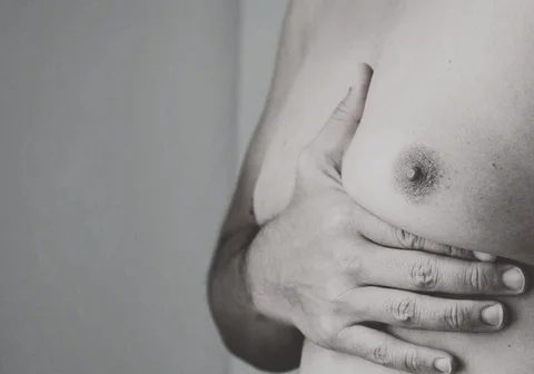 Glandular Gynecomastia