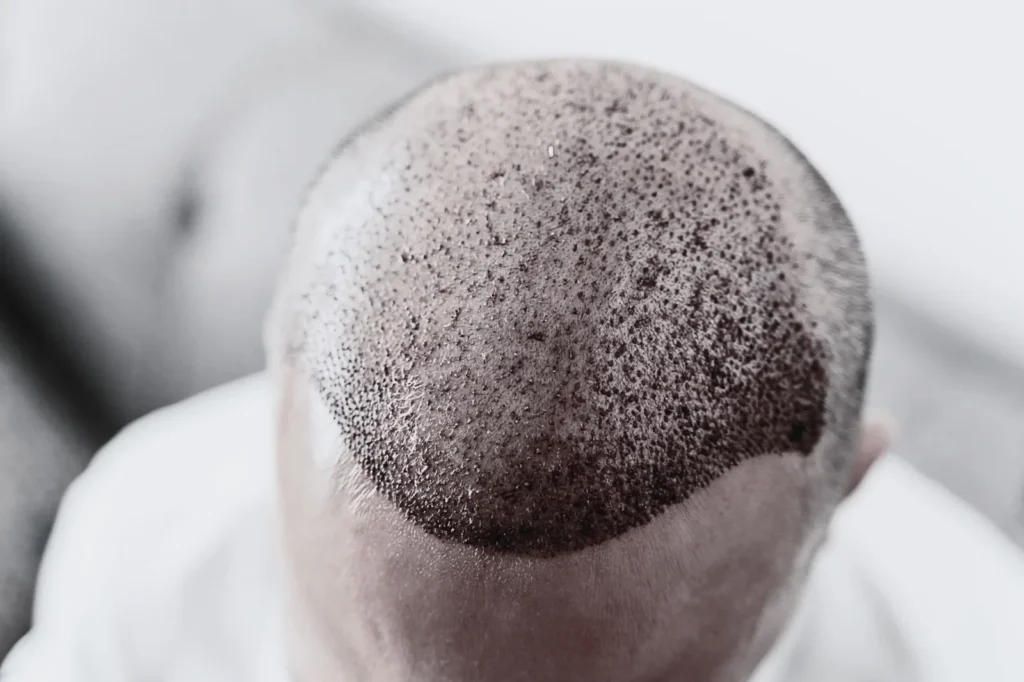 Hair Transplant