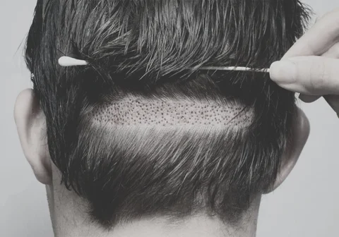 Follicular Unit Transplantation