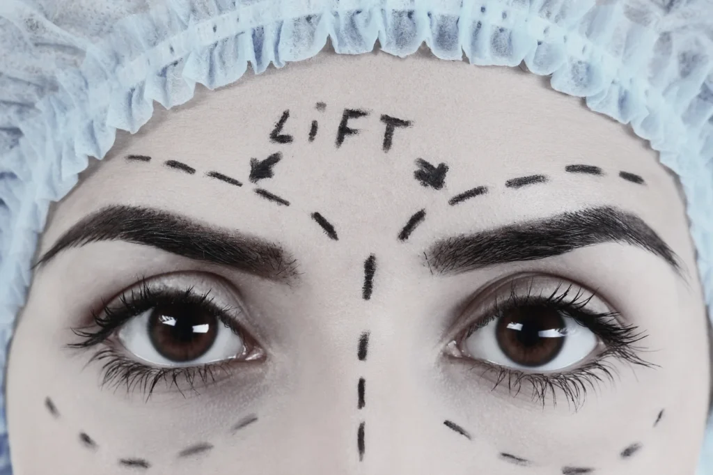 Forehead Lift