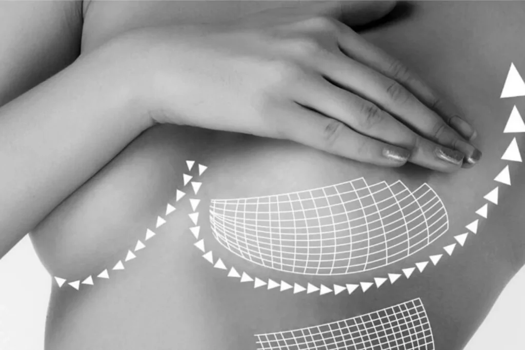 Breast Lift