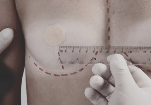 Periareolar Breast Lift