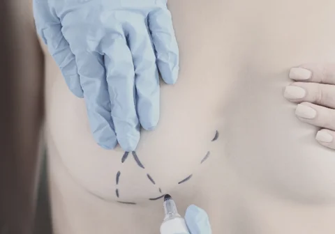 Liposuction-Assisted Reduction