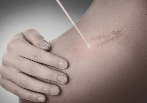 Laser Scar Treatment