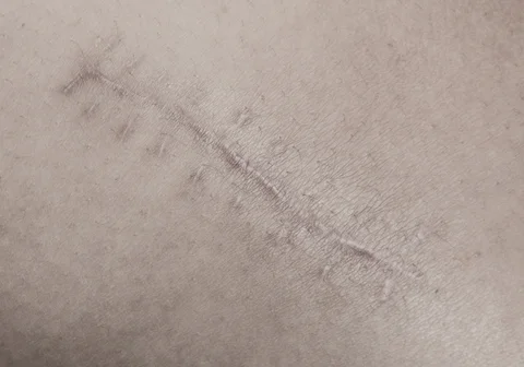 Scar Revision Surgery