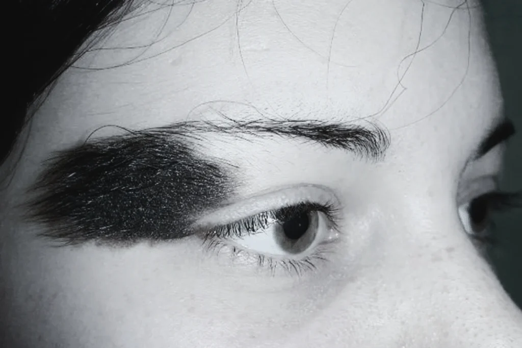 Congenital Hairy Nevus