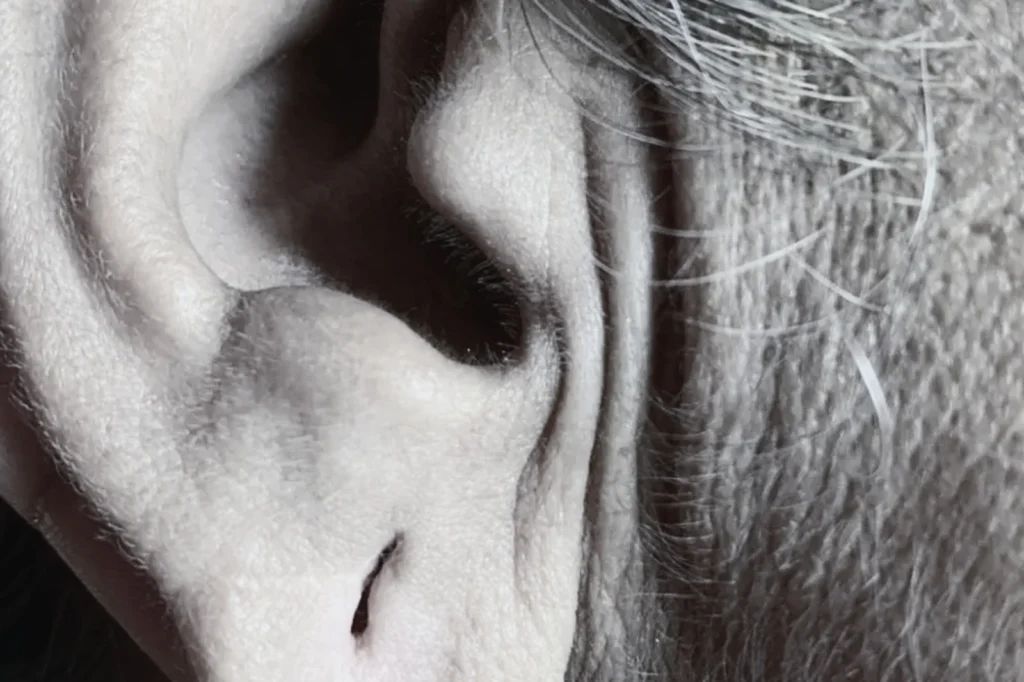 Earlobe Repair Surgery