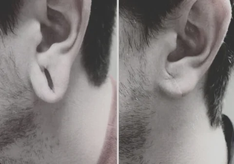 Stretched Hole Recorrection