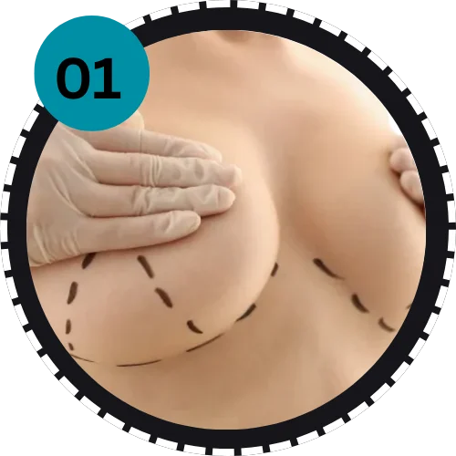 Breast Surgery